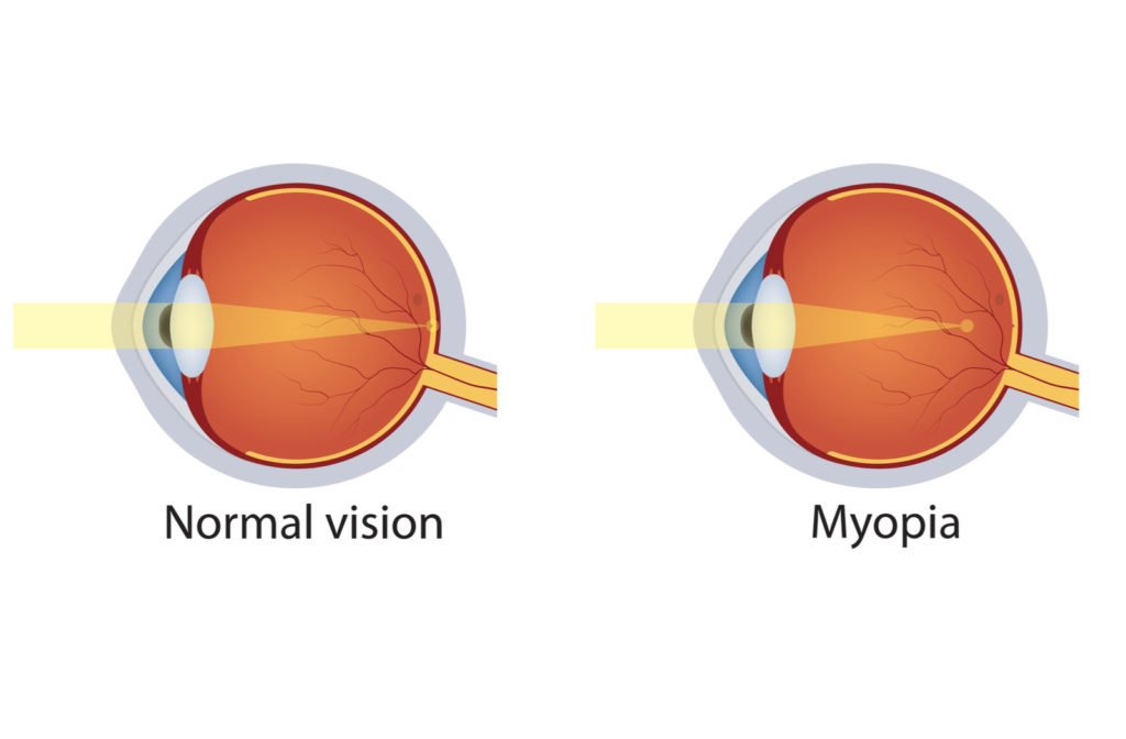 Illustration of normal vision on left and eyes with myopia on right