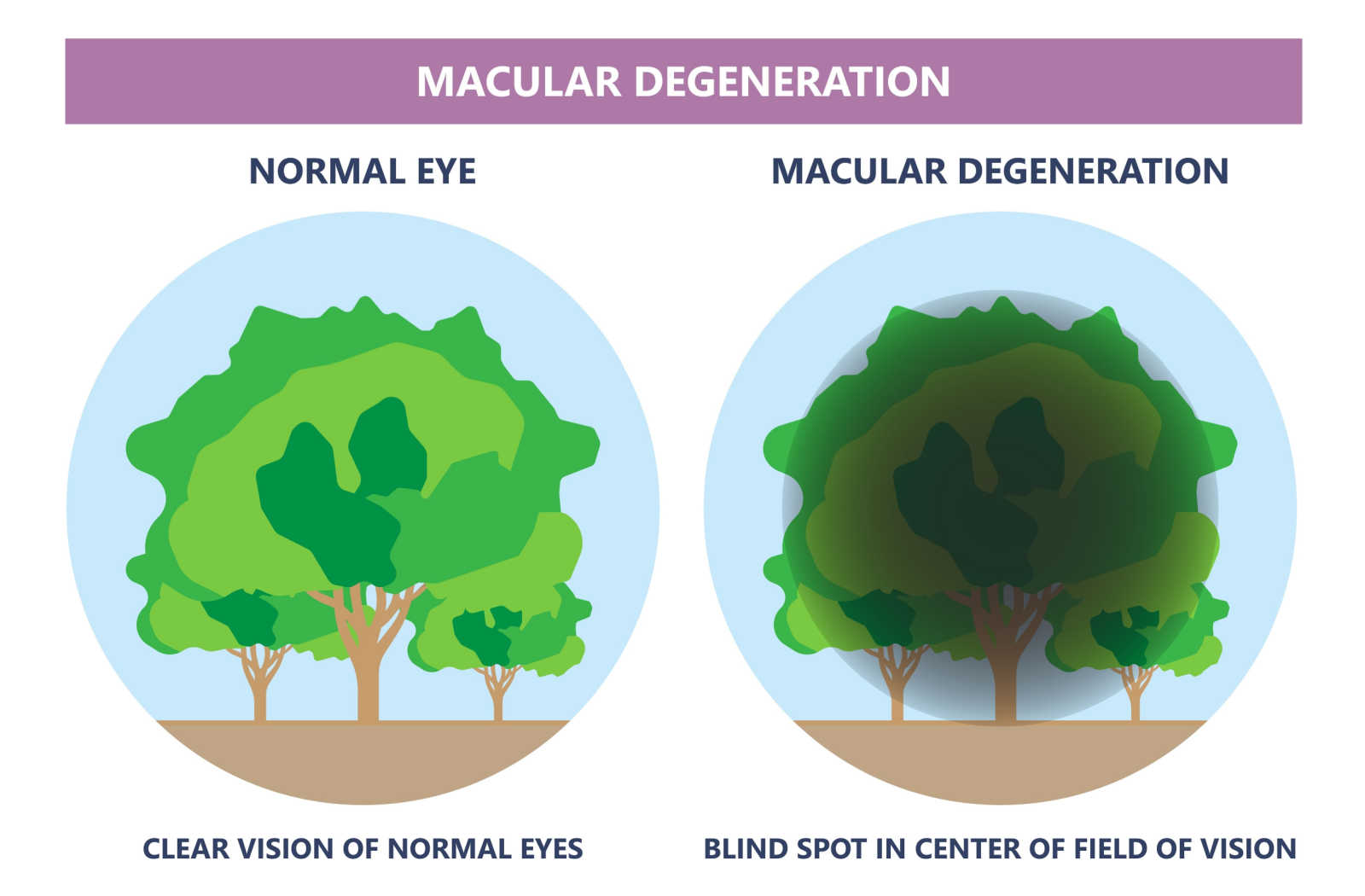 Graphical depiction of the sight of someone with a normal eye compared to macular degeneration.