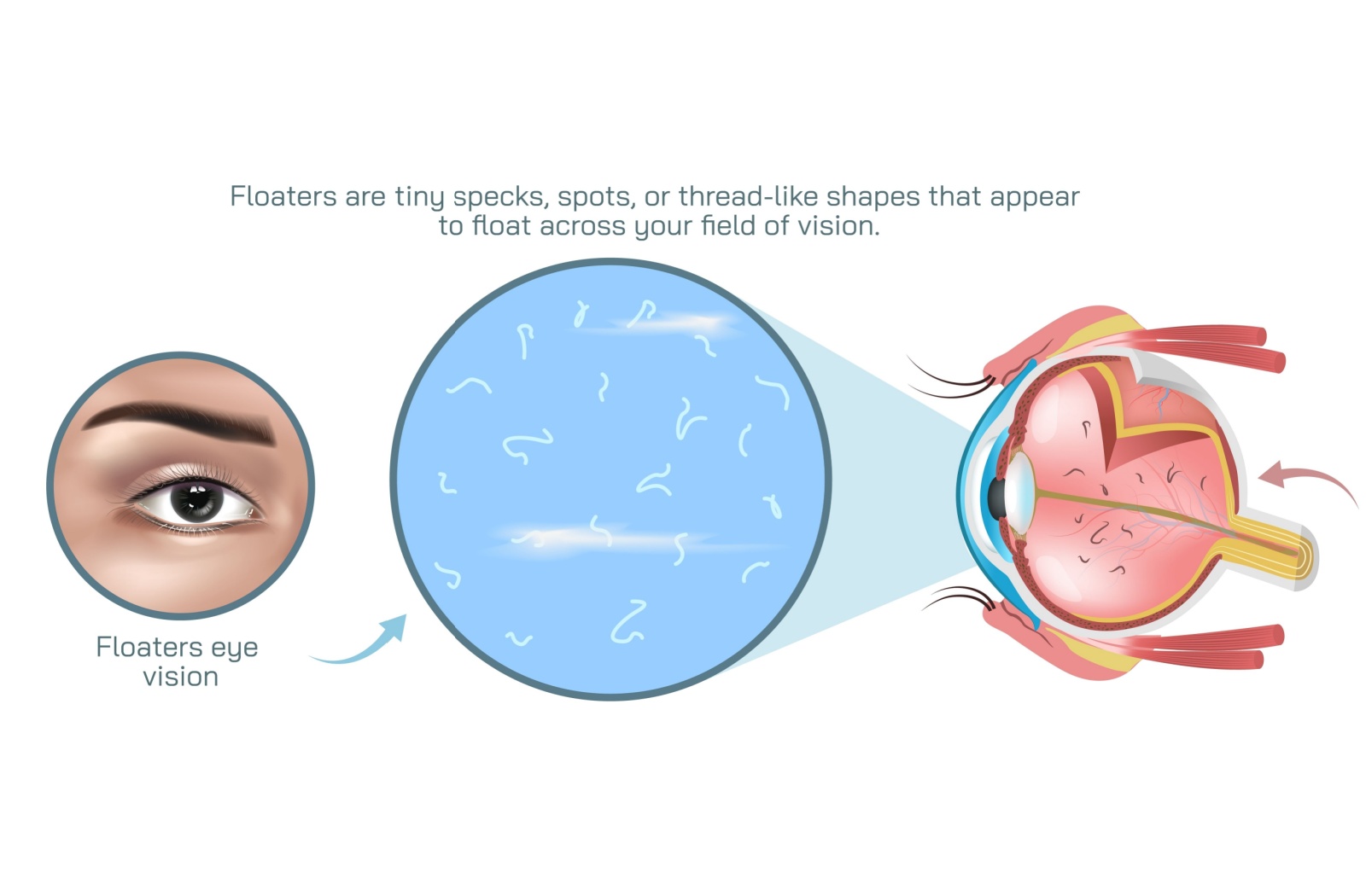 Infographic showing eye floaters in the vitreous fluid and field of vision.