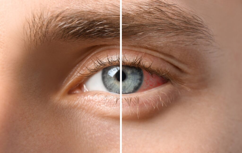 An eye is shown before and after meibomian gland restoration. On one side the eye is clear, on the other it is swollen.