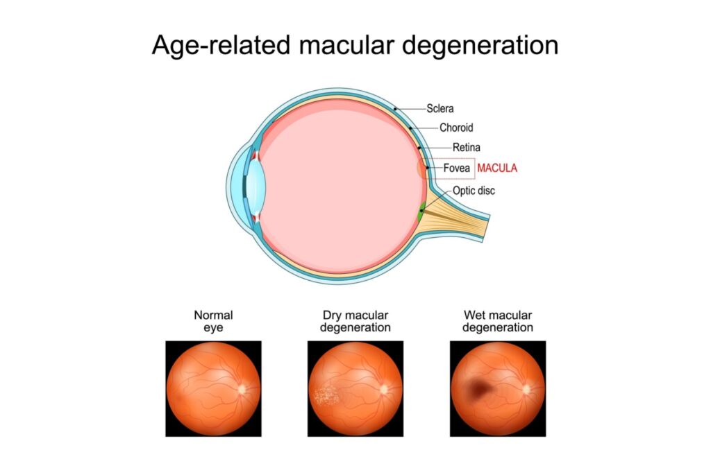 Diagram showing age-related macular degeneration. Cross-section of the eye labels the sclera, choroid, retina, fovea, macula, and optic disc. Below are three retinal images: a normal eye, an eye with dry macular degeneration showing yellow deposits, and an eye with wet macular degeneration showing a dark central spot.