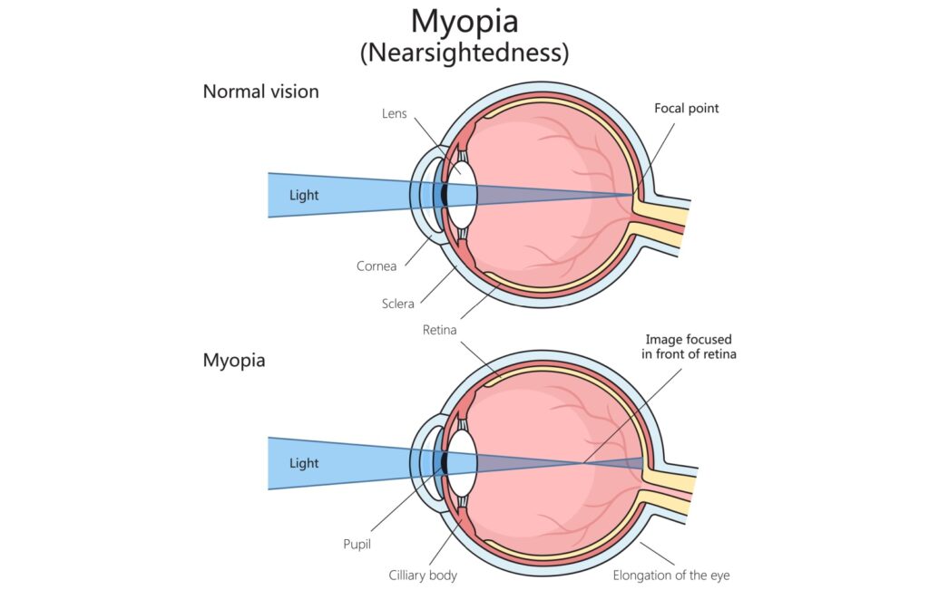 Medical diagram comparing normal vision and myopia, showing how light focuses on the retina versus in front of it.