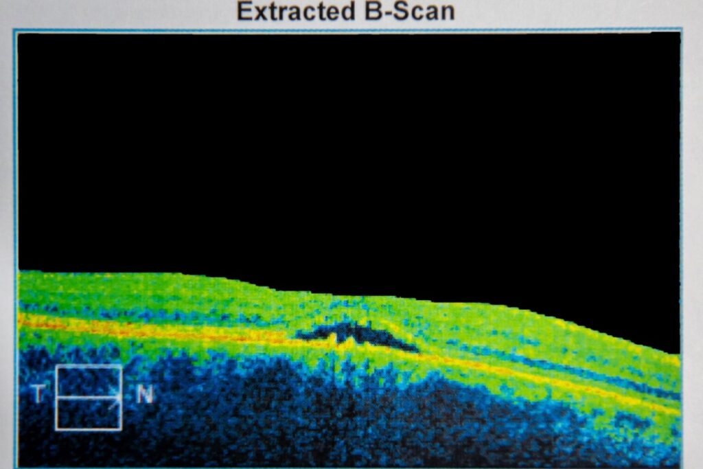 Cross-sectional OCT B-scan image of the retina showing macular changes commonly associated with age-related macular degeneration.