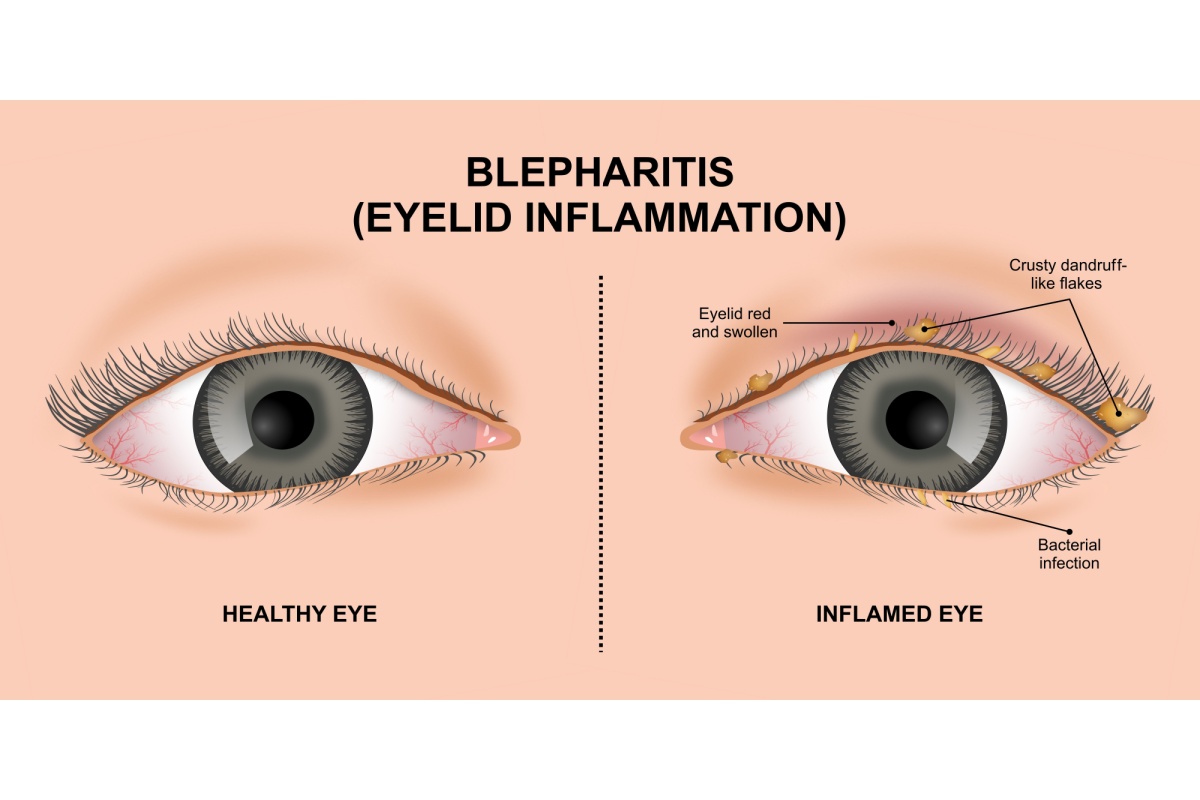 Medical illustration comparing healthy eye to eye with blepharitis showing eyelid inflammation, crusty dandruff-like flakes along lash line, redness, swelling, and bacterial infection.
