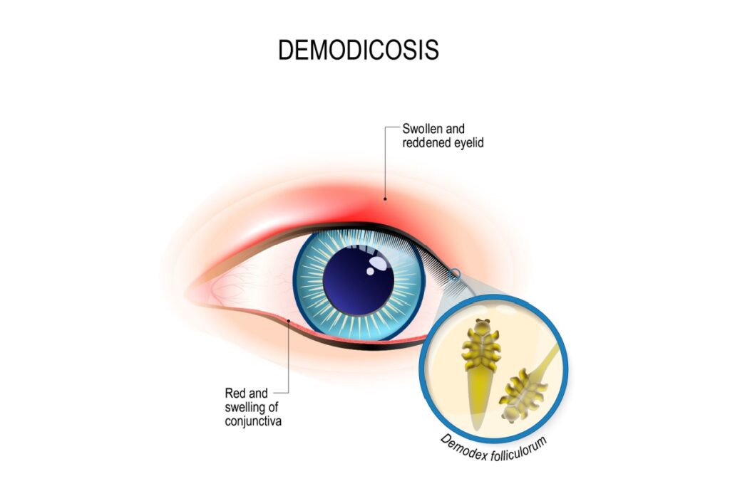 Medical diagram illustrating demodicosis caused by Demodex folliculorum mites showing swollen reddened eyelid, inflamed conjunctiva, and microscopic view of Demodex mites in hair follicles.