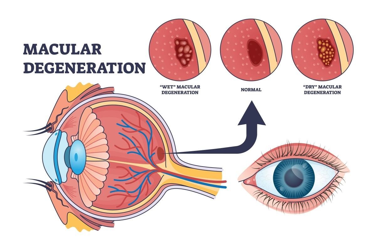 Macular degeneration diagram showing a cross-section of the eye with the macula highlighted, alongside comparisons of normal, dry (drusen deposits), and wet (abnormal blood vessels) forms.